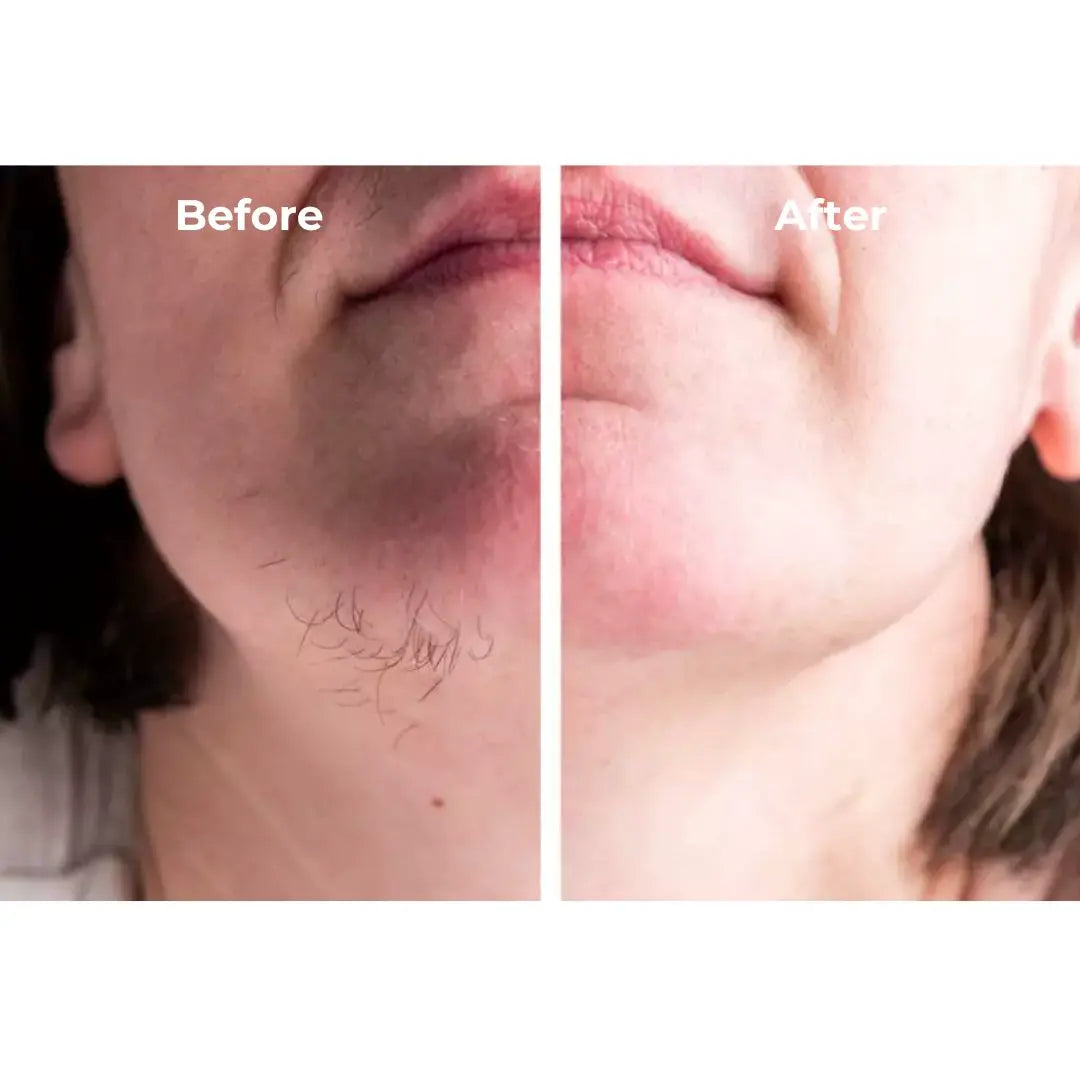 Haarentferner Stift Set